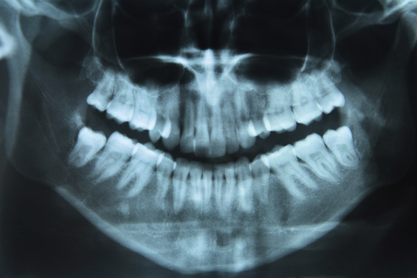 x-ray of teeth