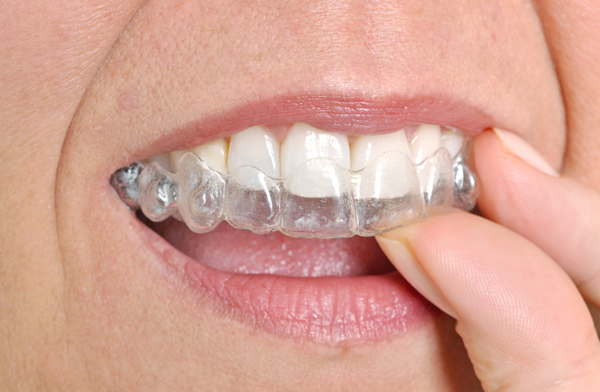 Invisalign brentwood ca