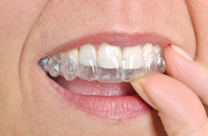 Invisalign® Clear Aligners - Alternative to braces