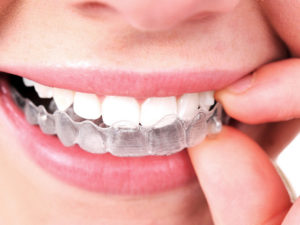 Invisalign in West Los Angeles
