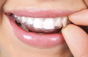 Invisalign in Brentwood, LA