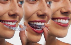 invisalign positioning