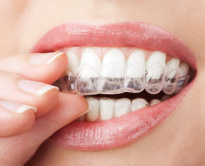 average cost of invisalign brentwood ca