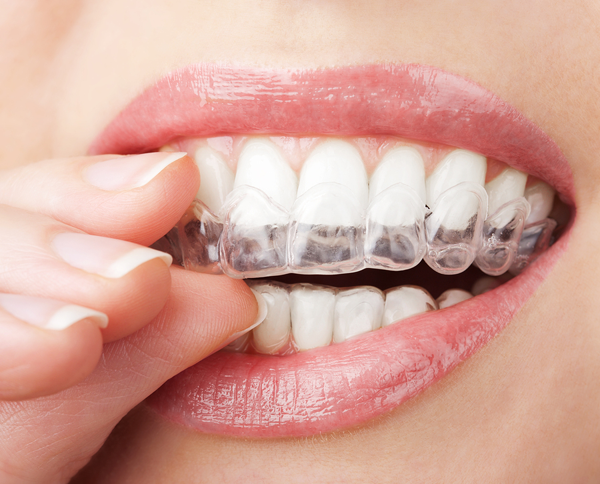 average cost of invisalign brentwood-ca