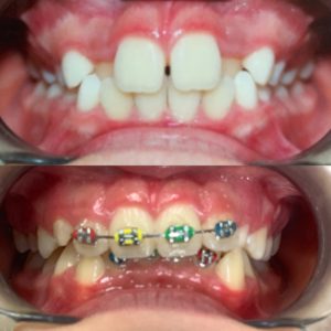 Orthodontic Treatment - Braces for Adults & Kids