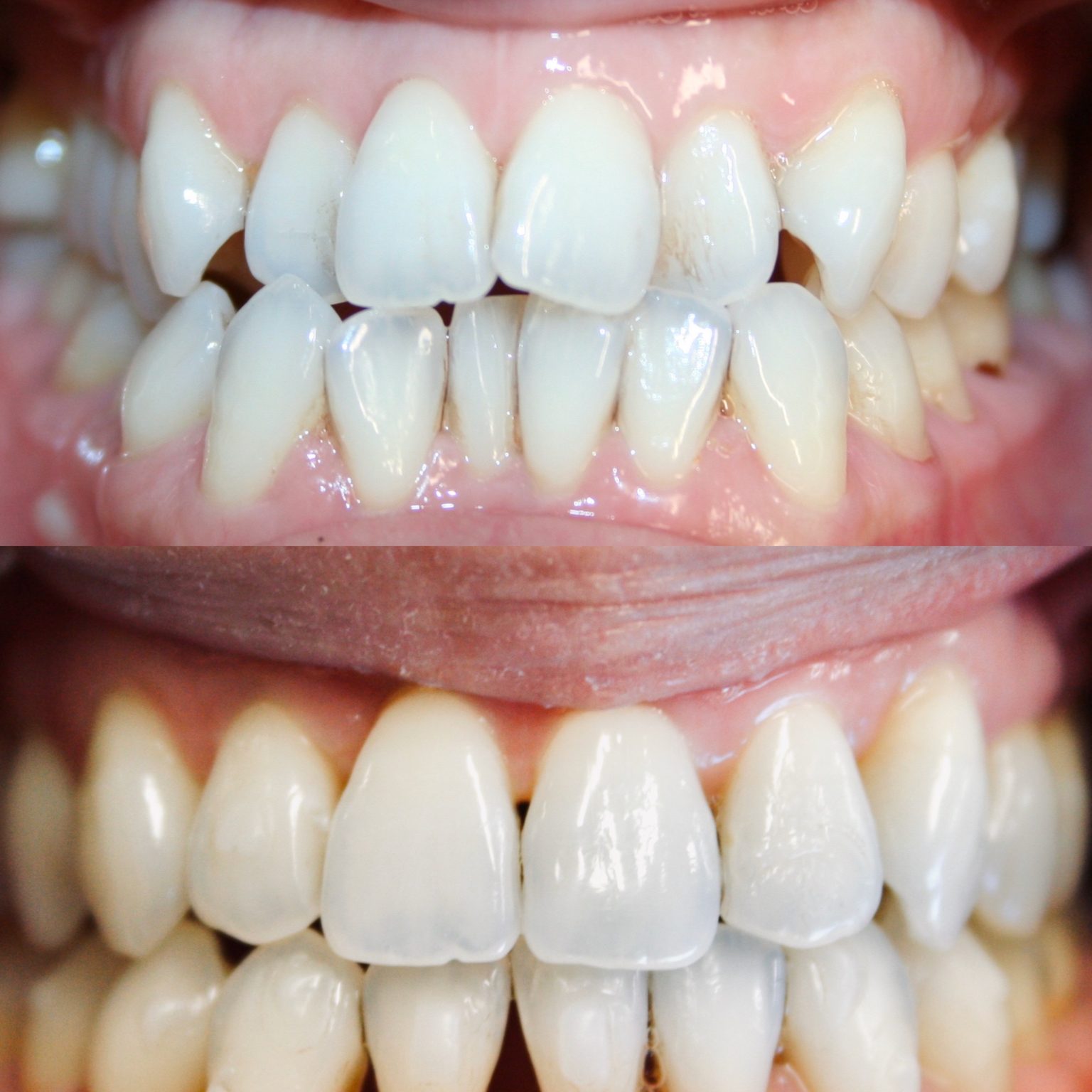 Invisalign Before And After Firouz Orthodontics West Los Angeles