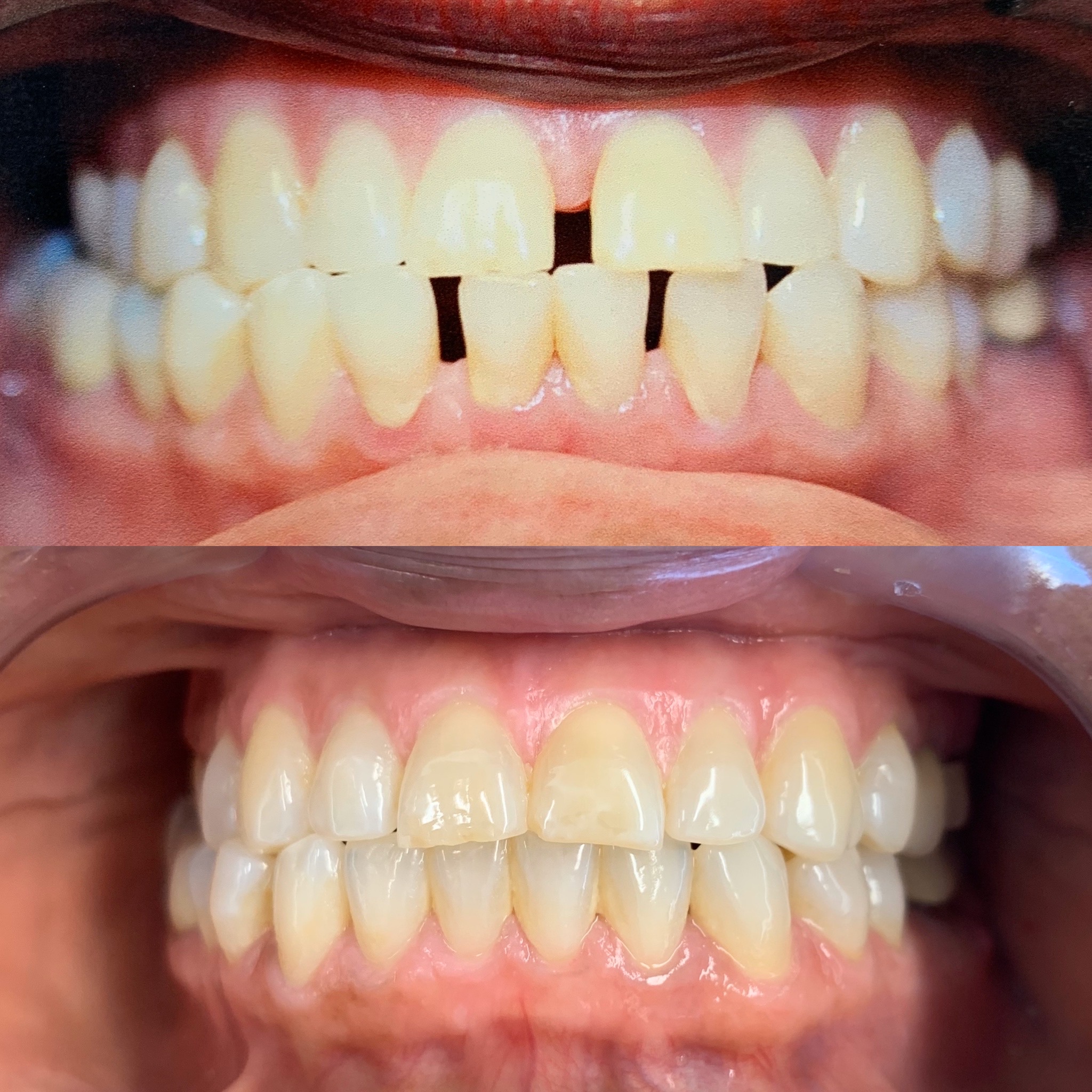 invisalign before and after gapped teeth