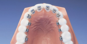 In-Ovation® LMTM braces, done by the experts at Firouz Orthodontics in West Los Angeles.