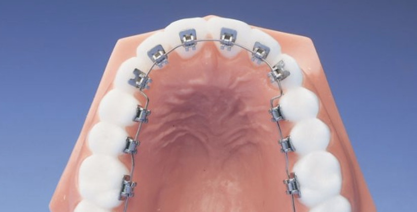What are Lingual Braces?